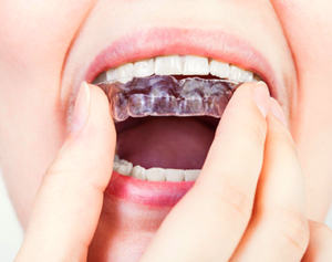 mouthguards
