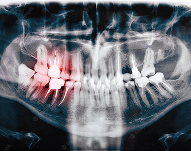 Dental X-rays
