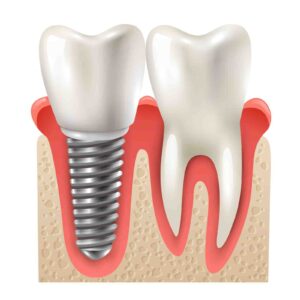 Dental Implants Beavercreek Ohio